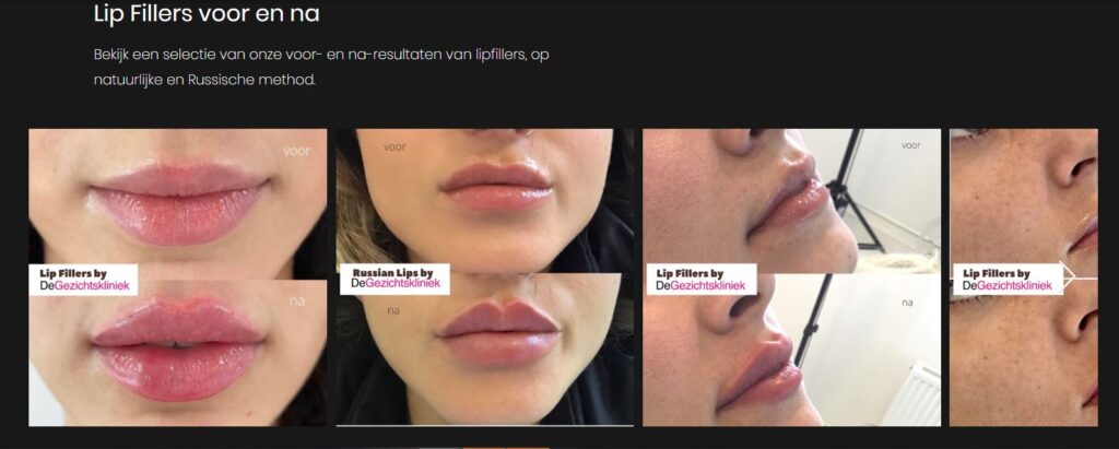 Best-Lip-Fillers-In-Amsterdam-By-De-Gezichtskliniek
