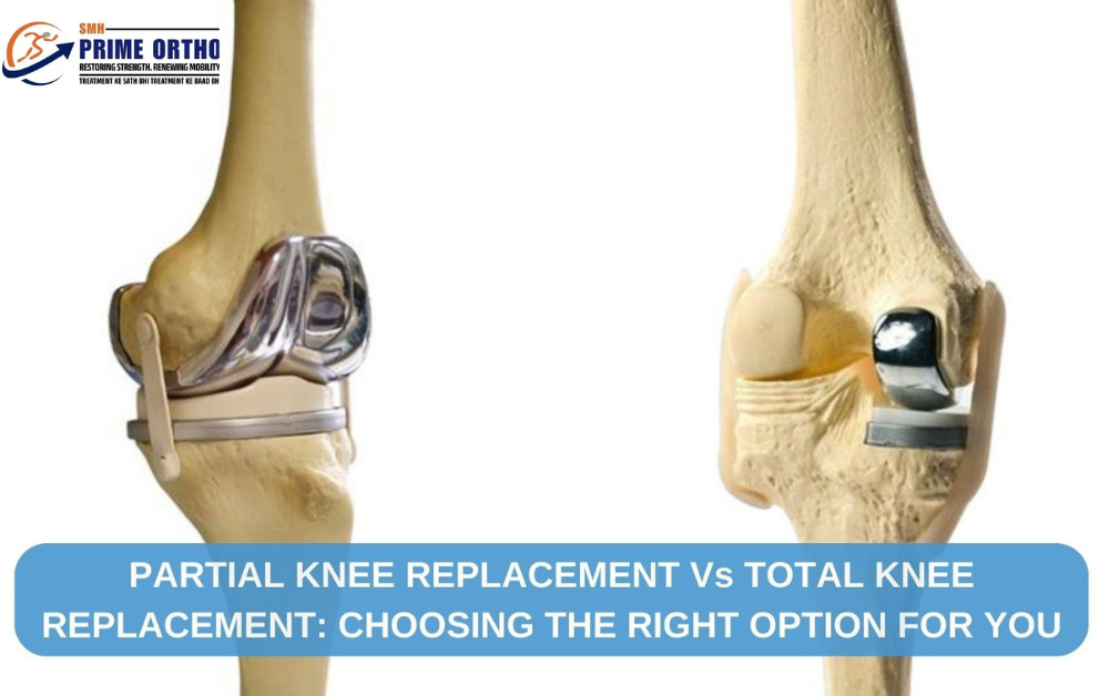 Best-Partial-Knee-Replacement-Surgeon-in-Delhi-NCR
