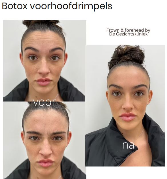 Botox-Voorhoofd-behandeling