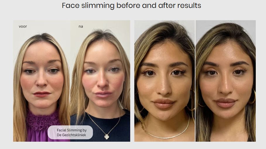 Get-a-Slimmer-Jawline-for-Only-E170