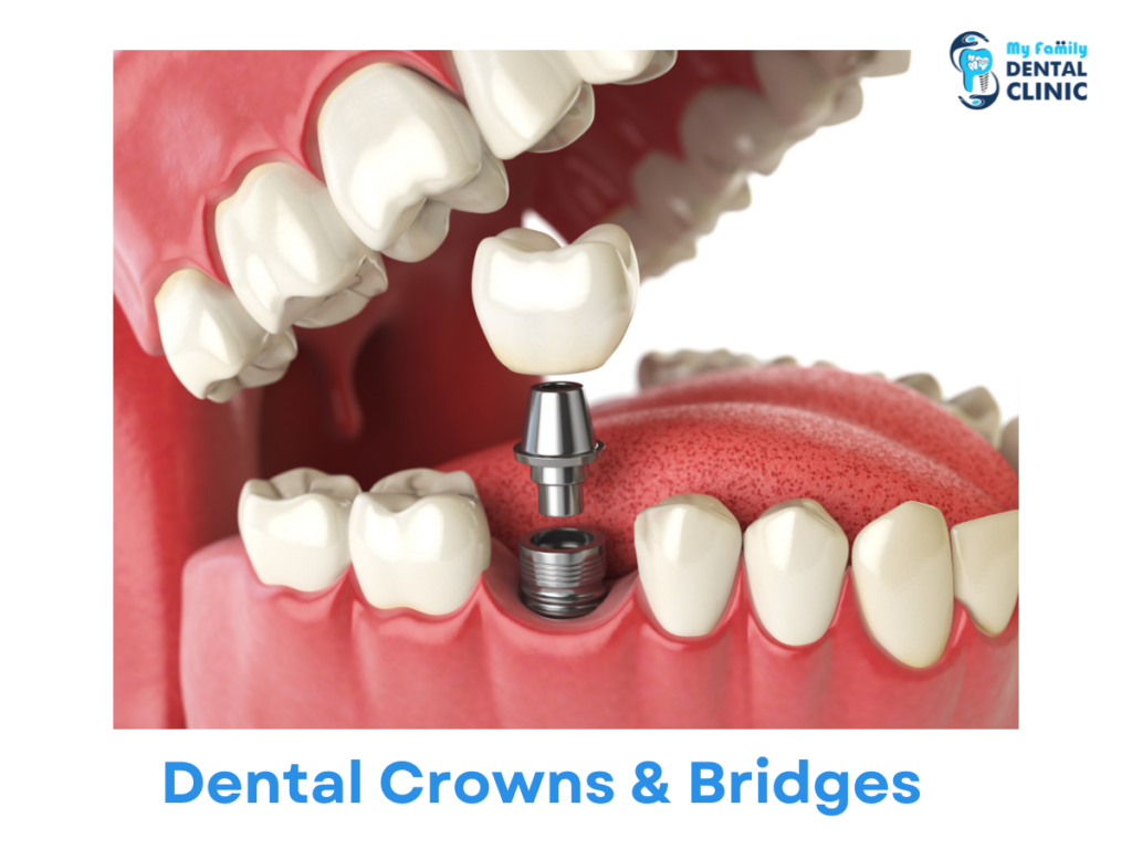 Dental-Crowns-Bridges-dental-clinic-in-karve-nagar-My-Family-Dental-Clinic