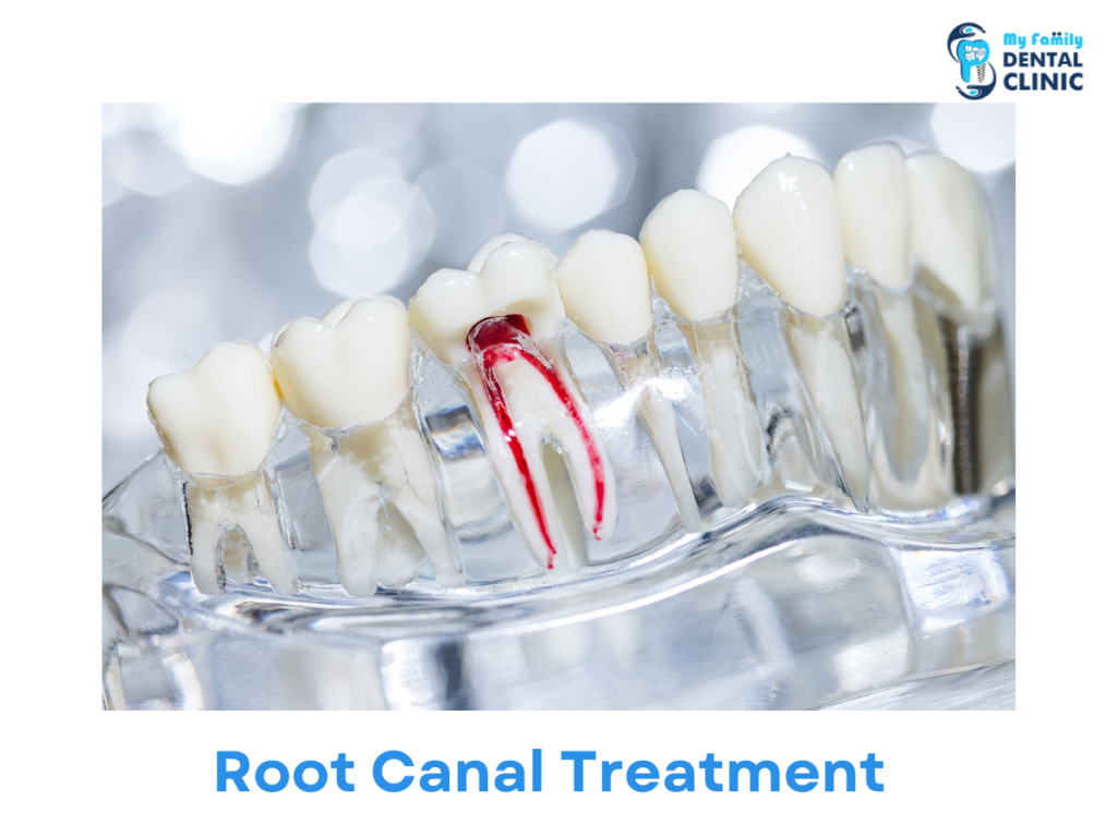 Root-Canal-Treatment-My-Family-Dental-Clinic-Pune